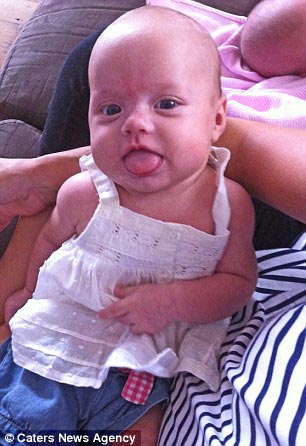 Оуши Варни, Ocea Varney, девочка родилась с большим языком, большой язык не закрывается рот, синдром Беквита-Видеманна