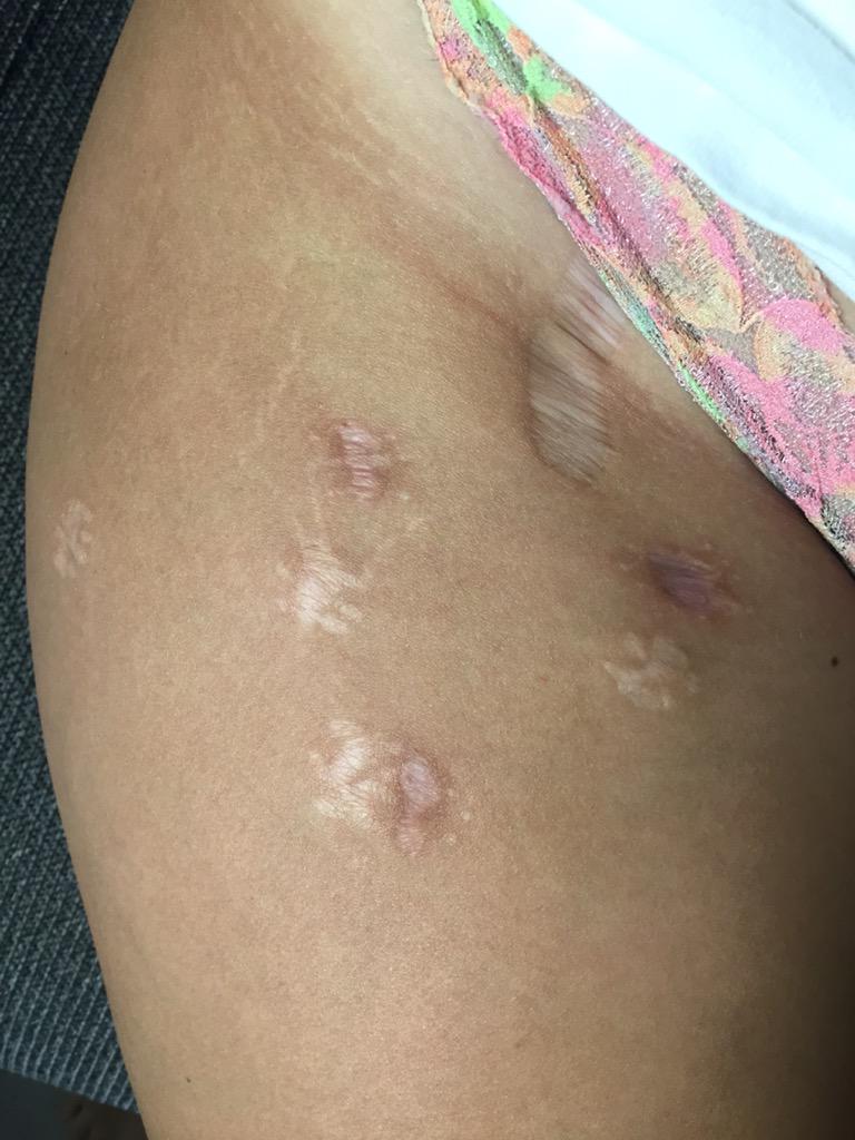 девушки показывают свои растяжки и целлюлит, #ThighReading