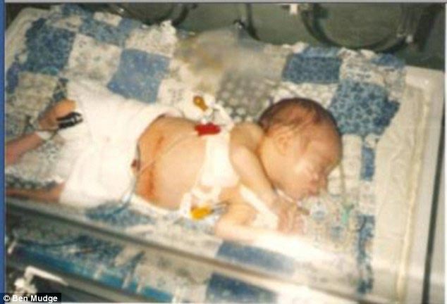 Парень с муковисцидозом вынужден тренироваться 5 раз в неделю, чтобы остаться в живых Парень с муковисцидозом, Бен Мадж, Ben Mudge