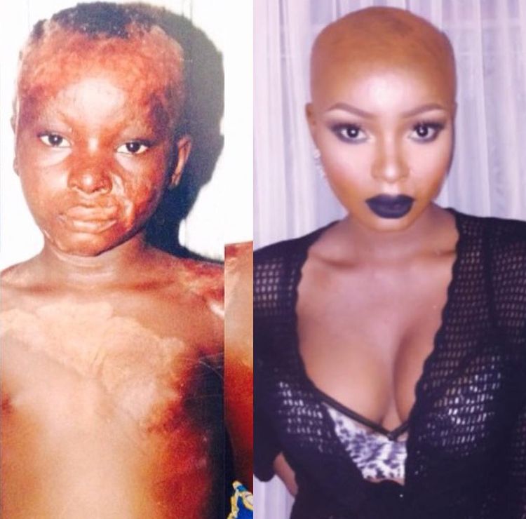 Девушка с ожогами стала визажистом, Шалом Нчом, Shalom Nchom