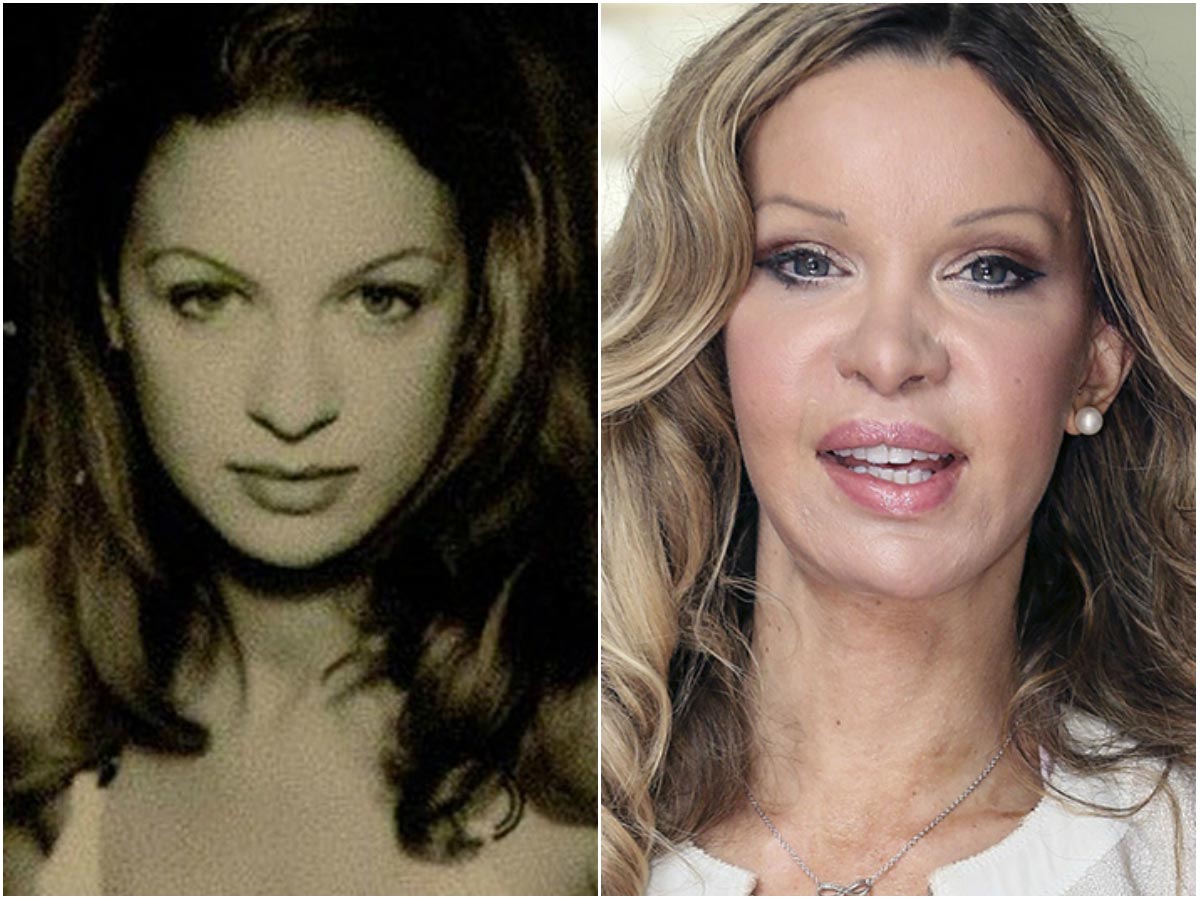 модели с неудачной пластикой, модели испортившие лицо пластикой