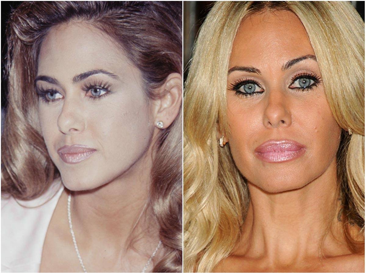 модели с неудачной пластикой, модели испортившие лицо пластикой