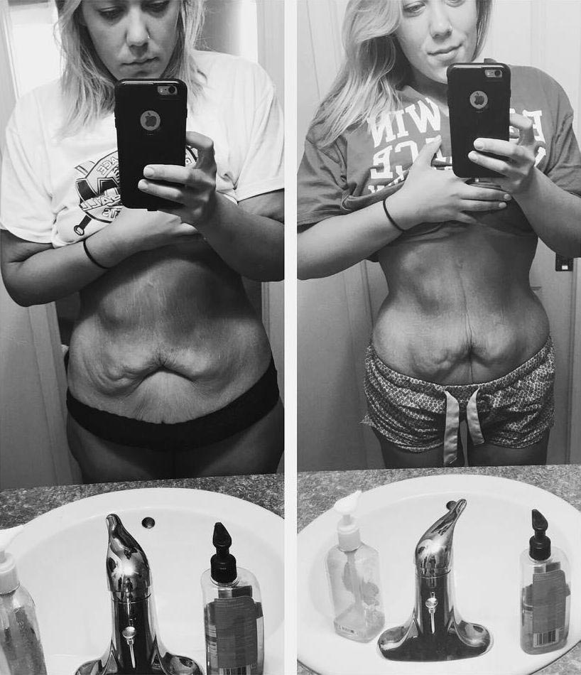 Эта девушка показала обратную сторону похудения, скрытую от посторонних глаз обратная сторона похудения, похудела на 72 кг, лишняя кожа после похудения