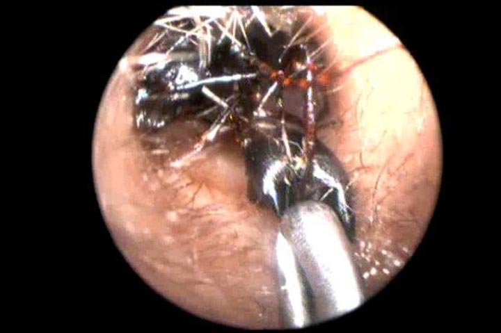 Муравьи из ушей девочки, 1000 муравьев их ушей девочки, муравьи в ушах, Шрея Дарджи, Shreya Darji