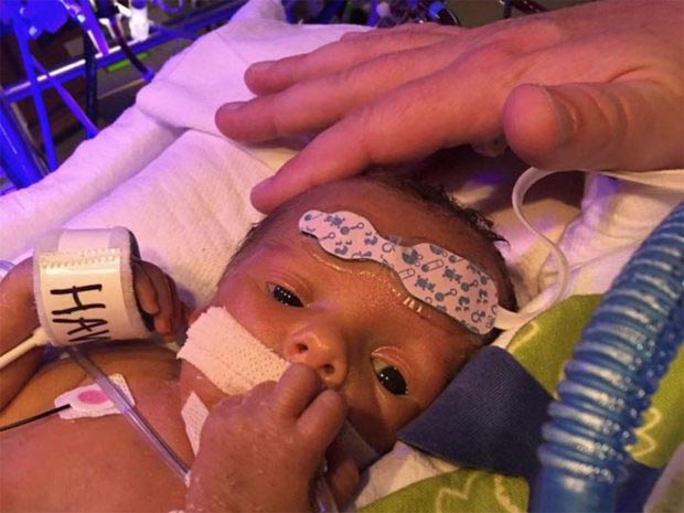 ребёнок обнимает умирающего близнеца, новорожденный ребенок прощается со своим близнецом