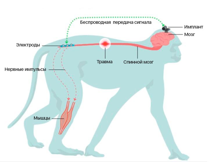 имплант в мозг макаки, имплант позволит парализованным людям ходить