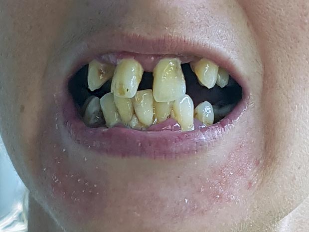 Нижние кривые зубы фото