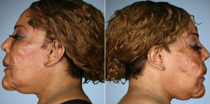 Раджи Наринесинг, Rajee Narinesingh, Раджи Наринесинг до и после, Раджи Наринесинг после восстановительной операции