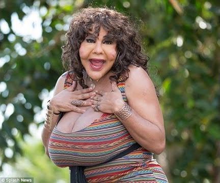 Раджи Наринесинг, Rajee Narinesingh, Раджи Наринесинг до и после, Раджи Наринесинг после восстановительной операции