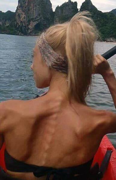 Девушка решила бороться с анорексией при помощи тяжёлой атлетики и её результат вас удивит победила анорексию, Софи Гажник, Sophie Gajnik, до и после анорексии, поборола анорексию тяжёлая атлетика