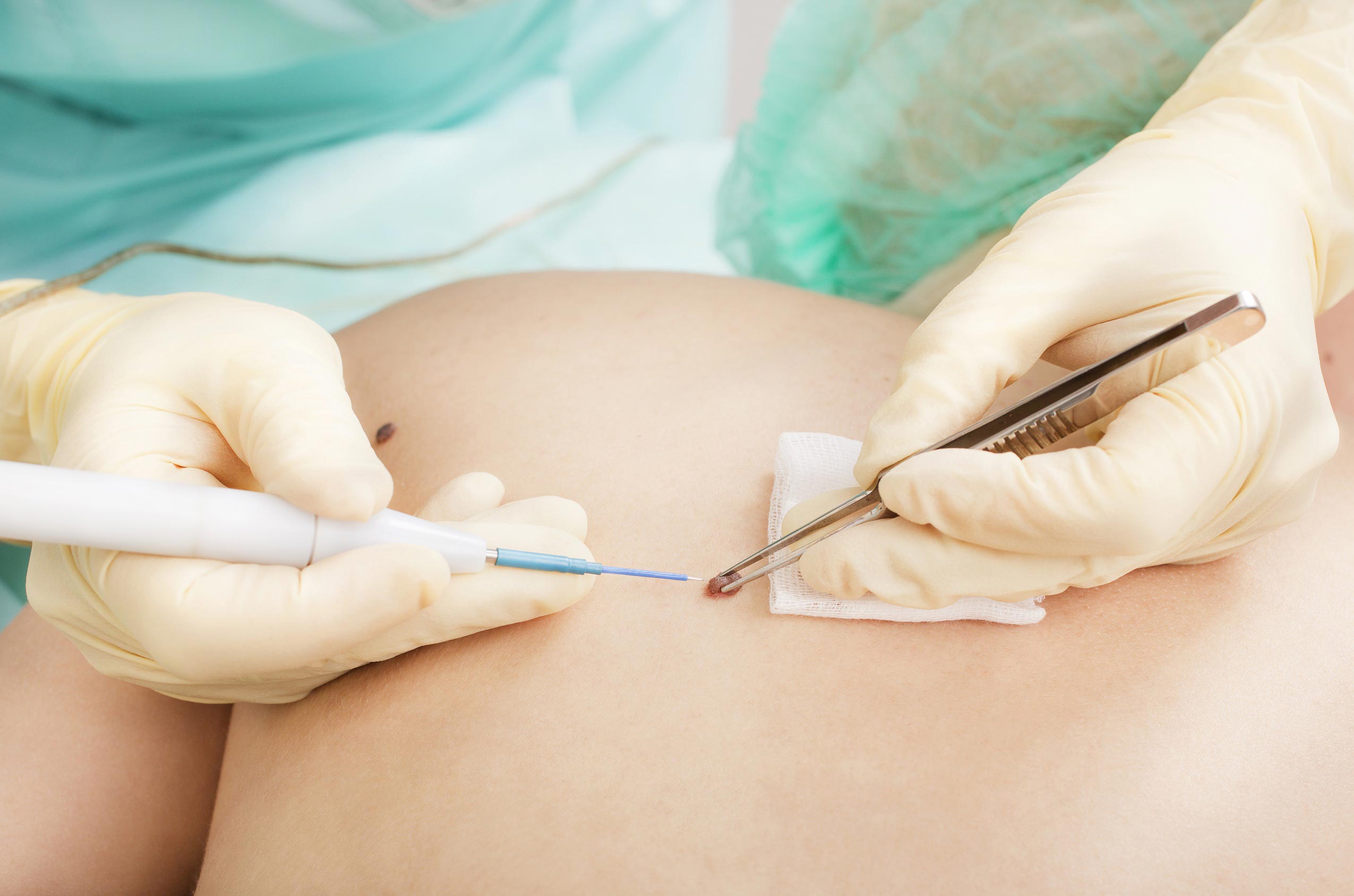 рак кожи, правда и мифы о раке кожи, меланома