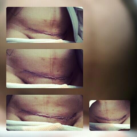 кесарево сечение лёгкий путь,женщина ответ на кесарево сечение это легко