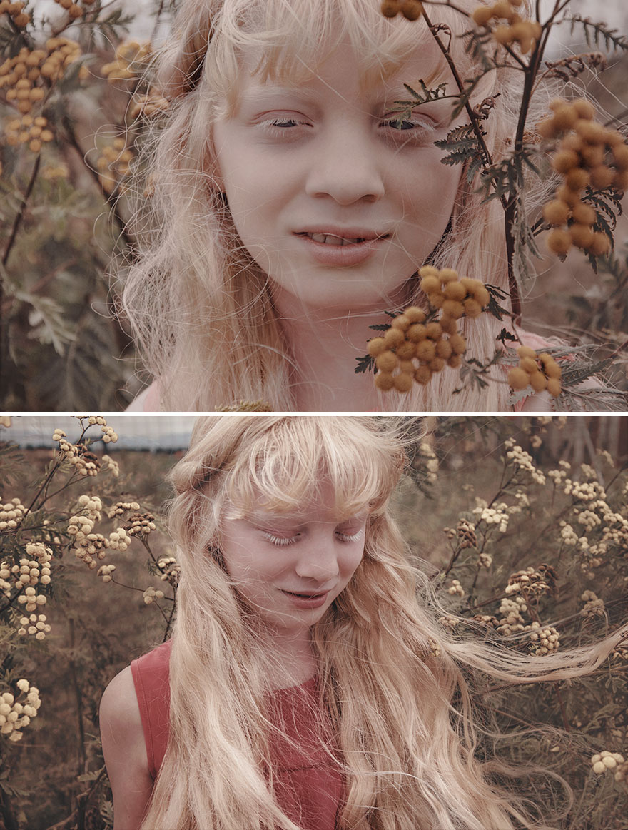 люди-альбиносы, люди с альбинизмом