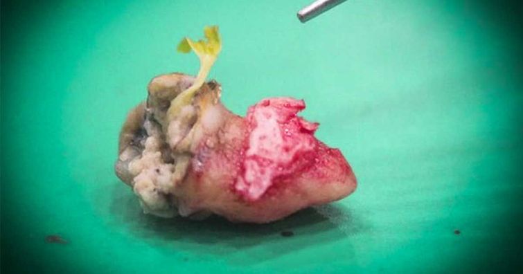 росток гуавы в зубе, в зубе новая жизнь, в зубе пророс росток, семечко в зубе проросло