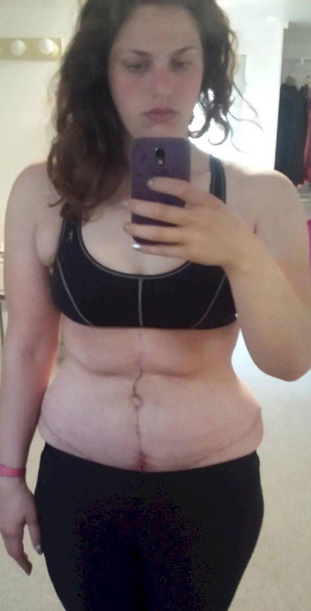 На двоих эта пара весила 320 кг, но они не только похудели в половину этого веса, но и избавиться от лишней кожи пара похудела в половину веса, пара весила 320 кг на двоих, пара до и после похудения