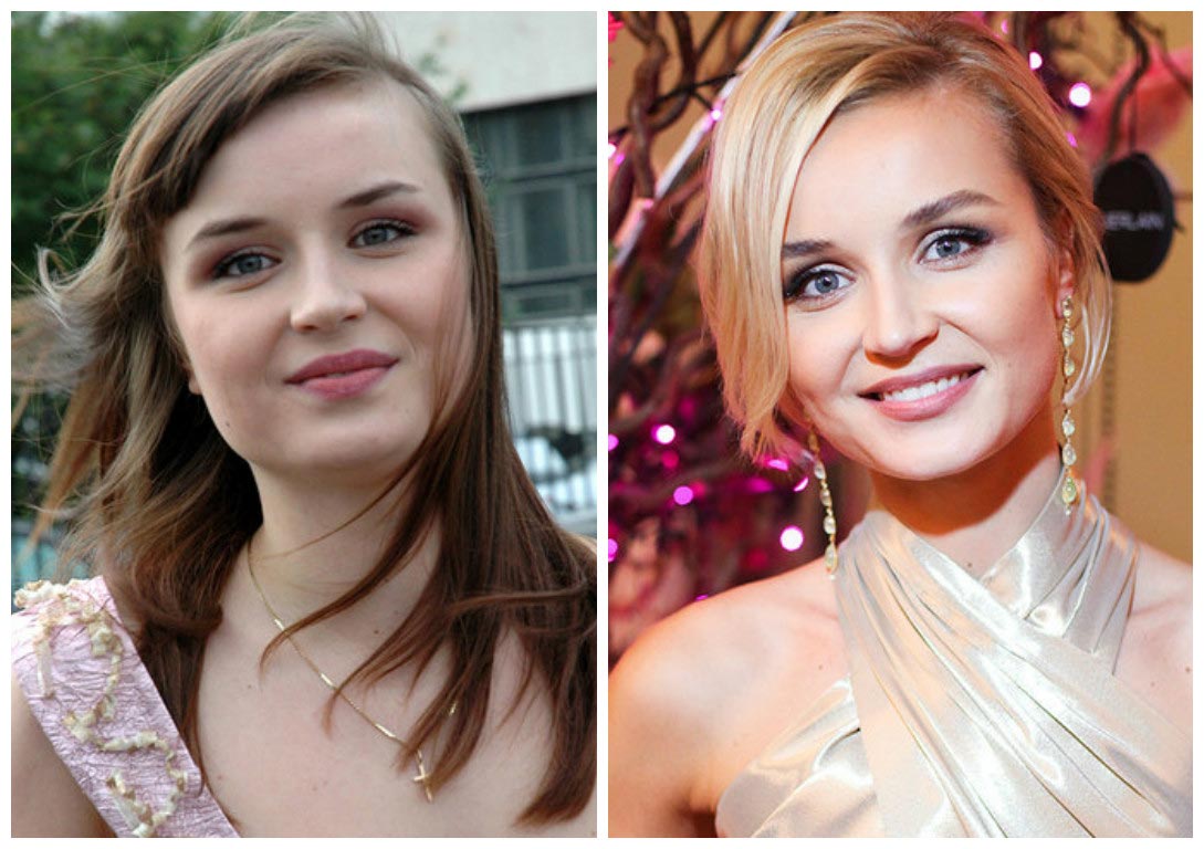 российские звёзды которые изменились до неузнаваемости, пластические операции звёзд 