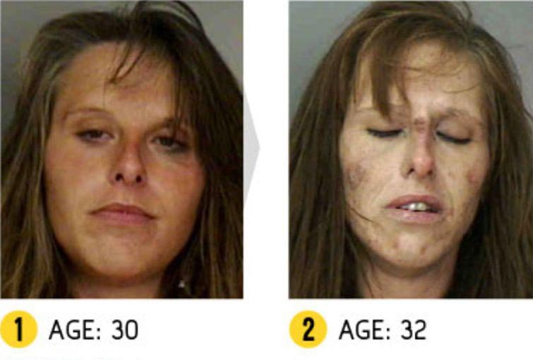 Лица до и после метамфетамина, люди до и после метамфетамина