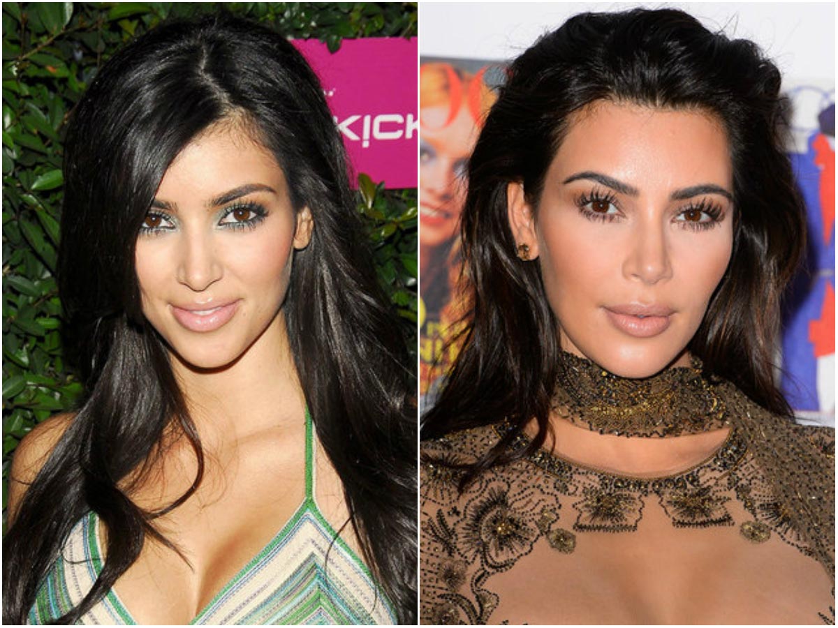 знаменитости коловшие себе ботокс, неудачная пластика знаменитостей