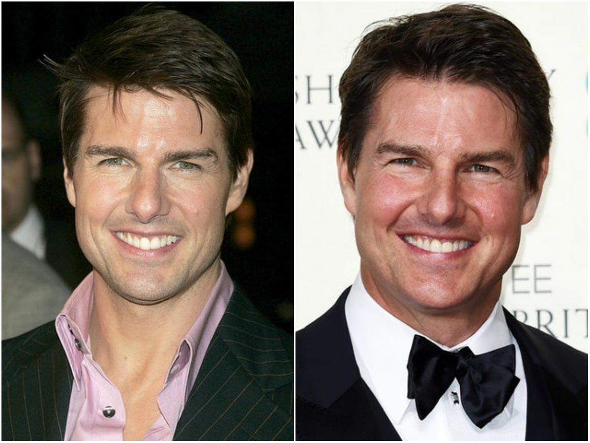 знаменитости коловшие себе ботокс, неудачная пластика знаменитостей