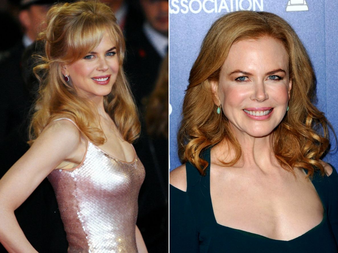 знаменитости коловшие себе ботокс, неудачная пластика знаменитостей