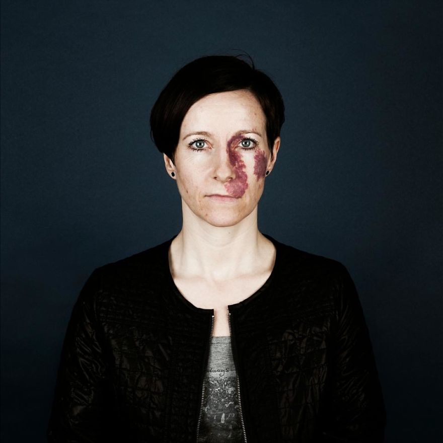 Портреты людей с родимыми пятнами, люди с родимыми пятнами,  Линда хансен, Nevus Flammeus