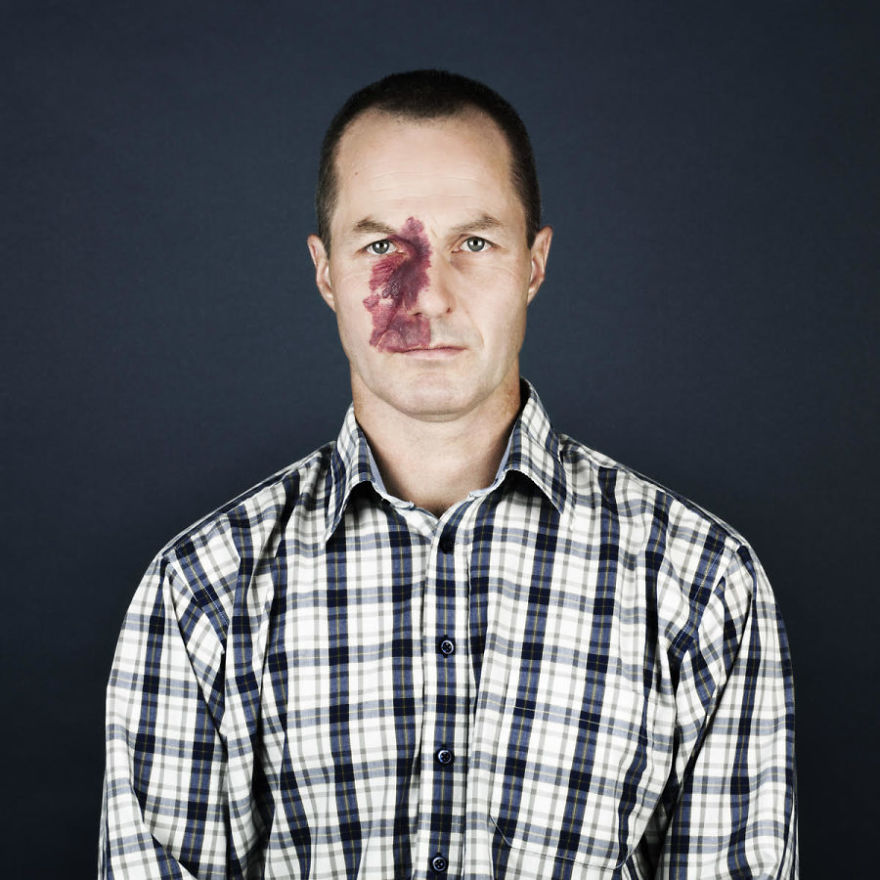 Портреты людей с родимыми пятнами, люди с родимыми пятнами,  Линда хансен, Nevus Flammeus