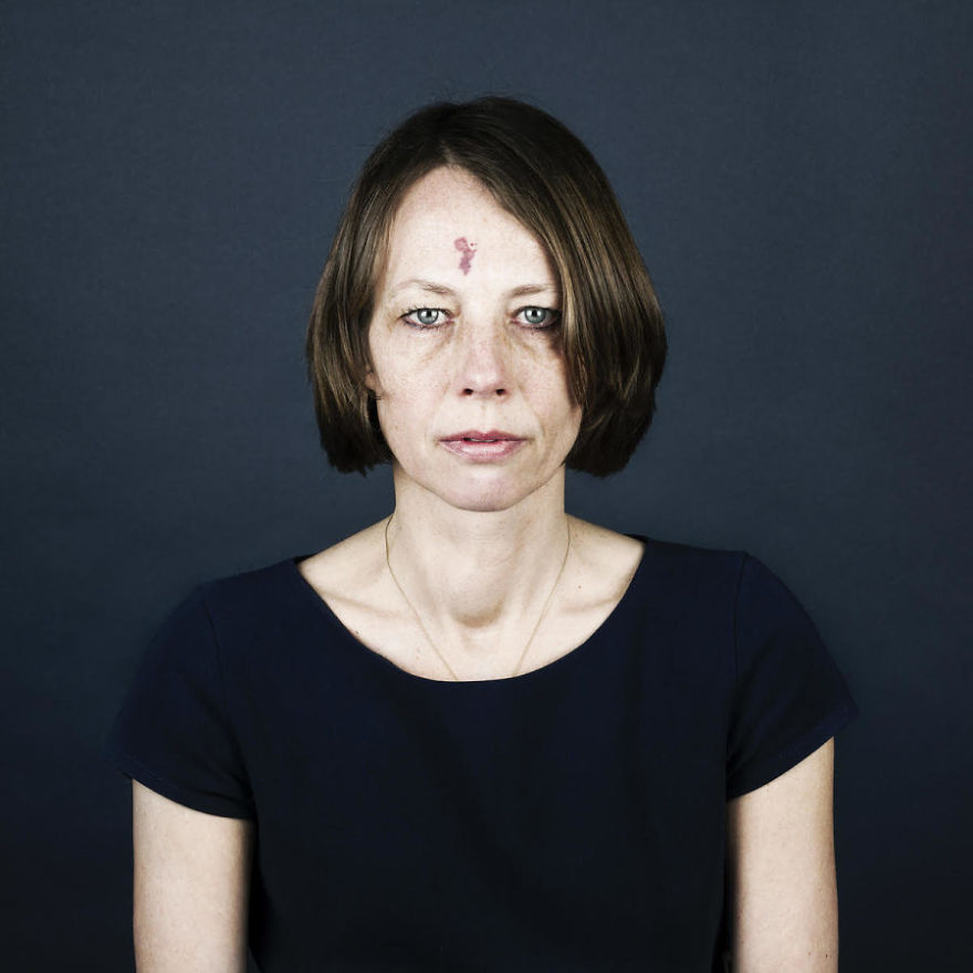 Портреты людей с родимыми пятнами, люди с родимыми пятнами,  Линда хансен, Nevus Flammeus