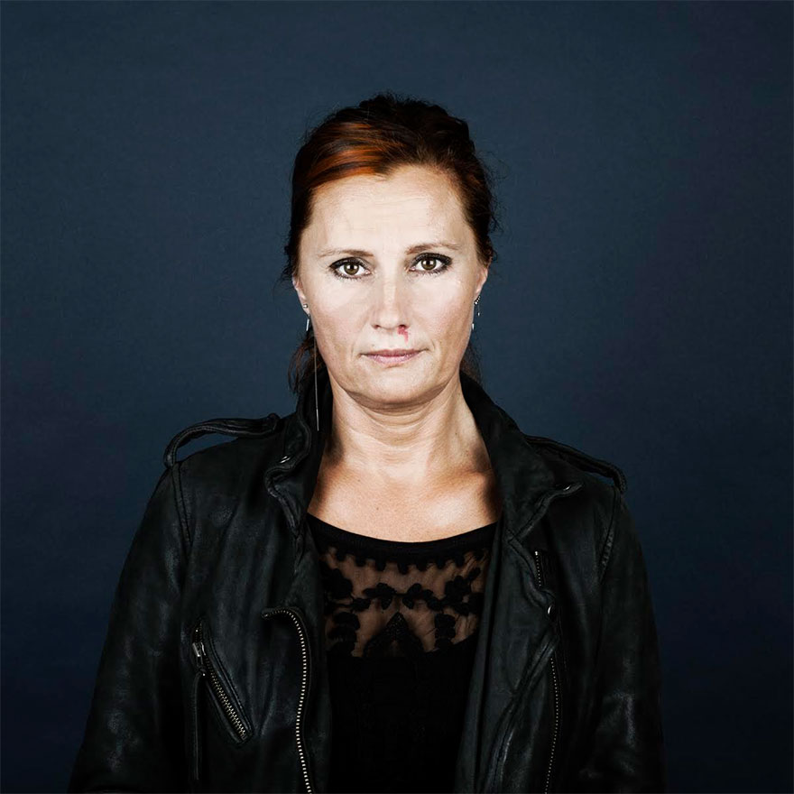 Портреты людей с родимыми пятнами, люди с родимыми пятнами,  Линда хансен, Nevus Flammeus