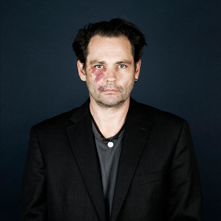 Портреты людей с родимыми пятнами, люди с родимыми пятнами,  Линда хансен, Nevus Flammeus