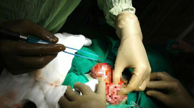 эмбрион в эмбрионе, ребёнок родился беременный другим ребёнком, ребёнок в ребёнке