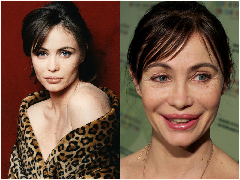 10 звёзд Голливуда, которым явно не повезло с пластическим хирургом неудачные пластические операции звёзд, звёзды с неудачной пластикой