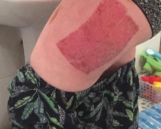 химический ожог покраска волос, красила волосы химический ожог, красила волосы осталась лысой