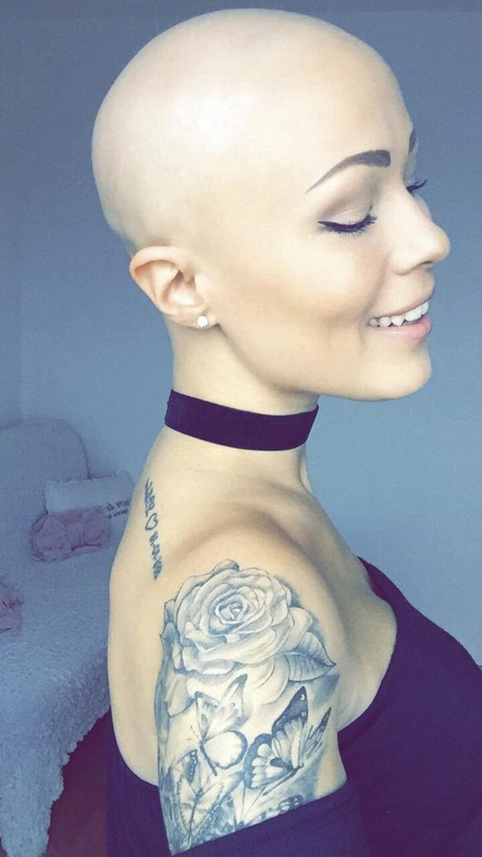 лысая модель, модель с алопецией, Тереза Хансон, Therese Hansson