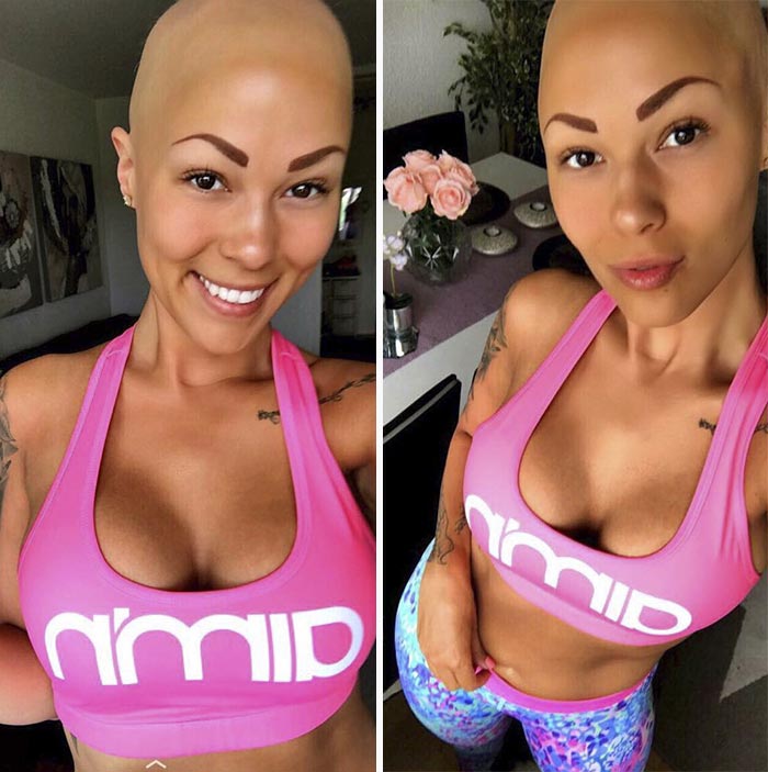 лысая модель, модель с алопецией, Тереза Хансон, Therese Hansson