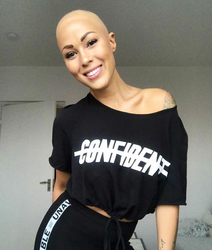 лысая модель, модель с алопецией, Тереза Хансон, Therese Hansson