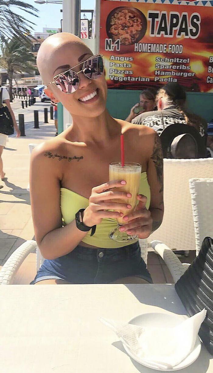 лысая модель, модель с алопецией, Тереза Хансон, Therese Hansson