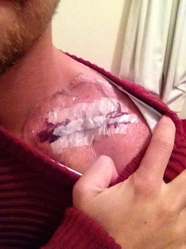 кольцо их хирургической пластины, пластина в ключице кольцо