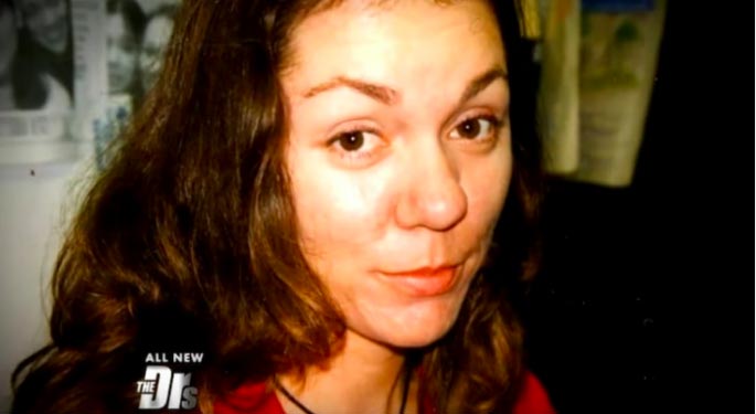 ринофима до и после, тяжёлая форма риноцеи, Памела Ичард, Pamela Ichard, ринофима у женщин