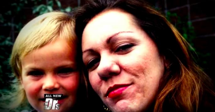 ринофима до и после, тяжёлая форма риноцеи, Памела Ичард, Pamela Ichard, ринофима у женщин