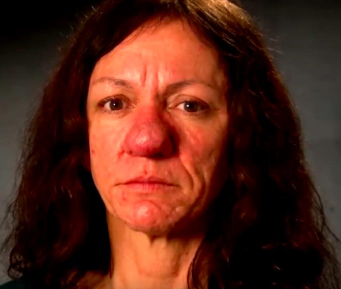 ринофима до и после, тяжёлая форма риноцеи, Памела Ичард, Pamela Ichard, ринофима у женщин