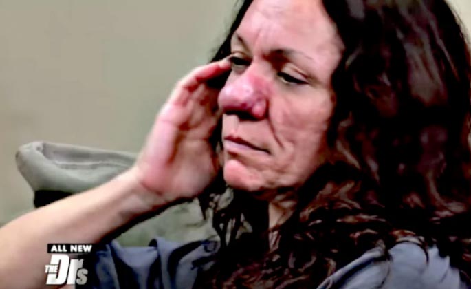 ринофима до и после, тяжёлая форма риноцеи, Памела Ичард, Pamela Ichard, ринофима у женщин