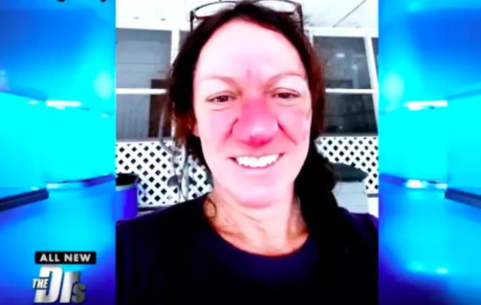 ринофима до и после, тяжёлая форма риноцеи, Памела Ичард, Pamela Ichard, ринофима у женщин