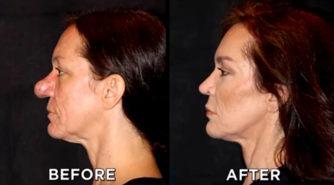 ринофима до и после, тяжёлая форма риноцеи, Памела Ичард, Pamela Ichard, ринофима у женщин