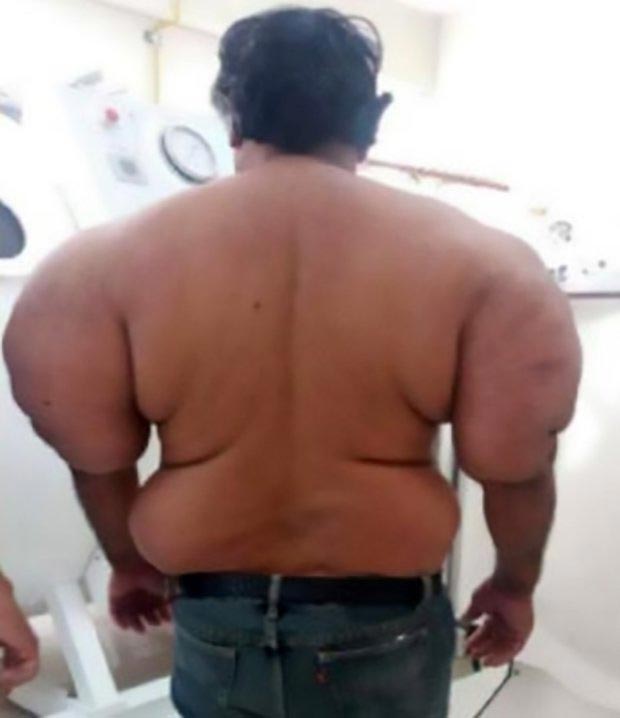 декомпрессионная болезнь, декомпрессионная болезнь симптомы, декомпрессионная болезнь последствия