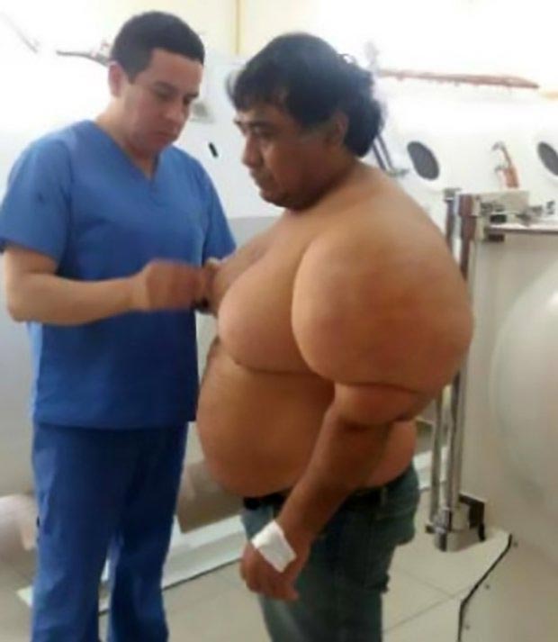 декомпрессионная болезнь, декомпрессионная болезнь симптомы, декомпрессионная болезнь последствия