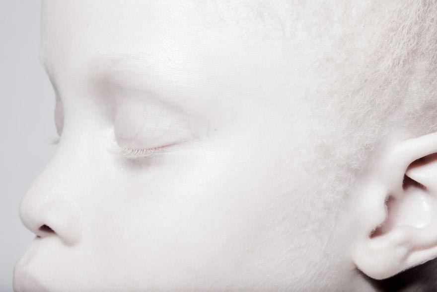 Темнокожие близнецы альбиносы, Лара и Мара Бавар, близнецы альбиносы из Бразилии, Lara Mara Bawar