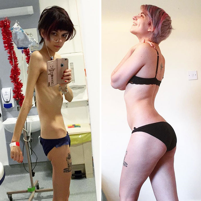 до и после анорексии, люди которые смогли победить анорексию. 