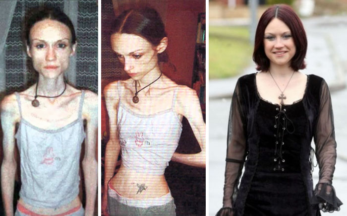 Анорексия фото девушек до и после