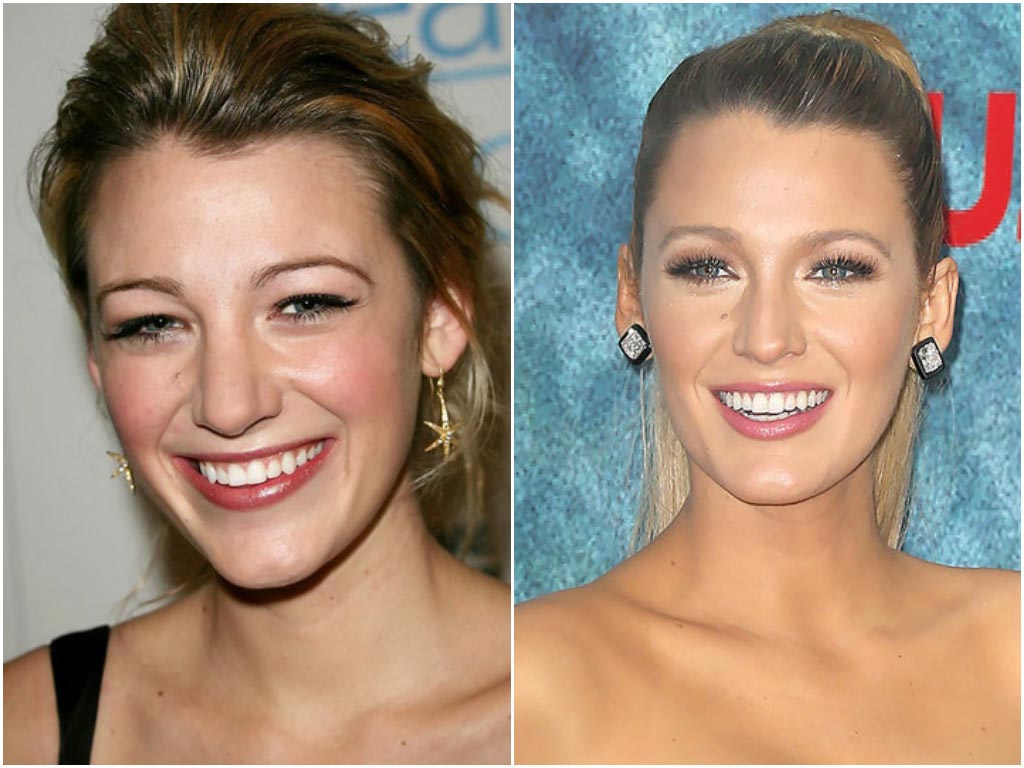 10 знаменитостей, сделавших пластические операции в юном возрасте пластические операции звёзд, звёзды сделавшие пластические операции в юном возрасте