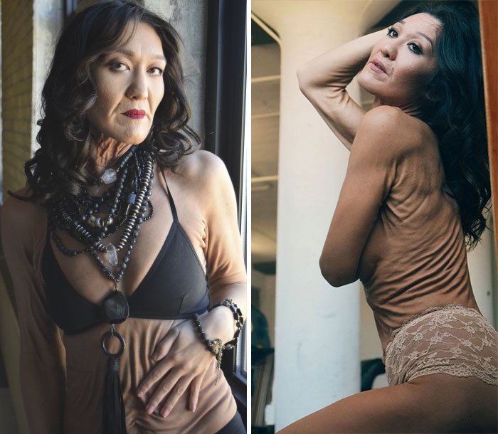 26-летняя модель которая выглядит на 50, Сара Гюртс, Синдром Элерса-Данлоса